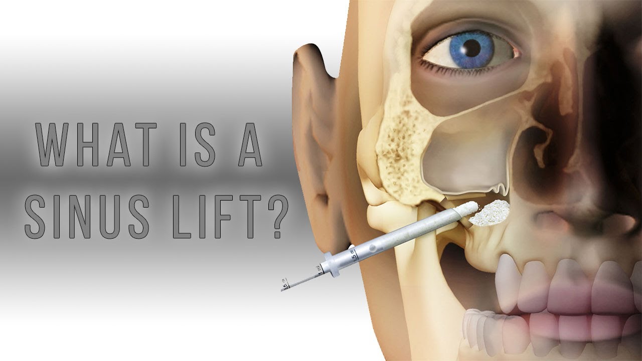 Sinus Lift – DentalClinic