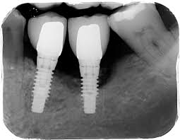 Traitement péri implantite